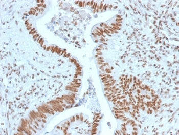 IHC staining of FFPE human colon carcinoma with Nucleophosmin antibody. HIER: boil tissue sections i
