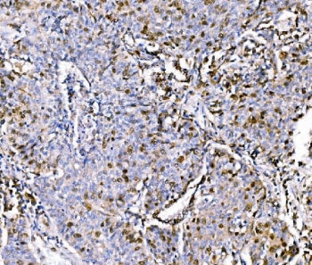 IHC staining of FFPE human lung cancer tissue with Geminin antibody. HIER: boil tissue sections in p