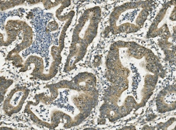 IHC staining of FFPE human rectal cancer with Gastrotropin antibody. HIER: boil tissue sections in p