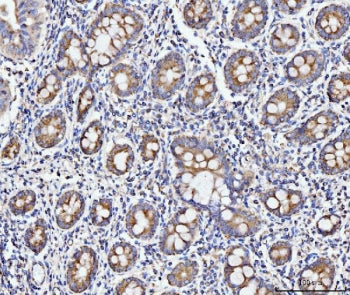 IHC staining of FFPE human gastric adenocarcinoma tissue with ECSIT antibody. HIER: boil tissue sect