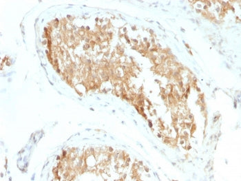 IHC staining of FFPE human testicular carcinoma with ALDH1A1 antibody (clone ALDH1A1/1381). HIER: bo