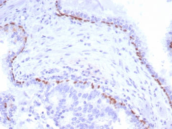 IHC staining of FFPE human prostate carcinoma tissue with p40 antibody (clone P40/8225R). HIER: boil