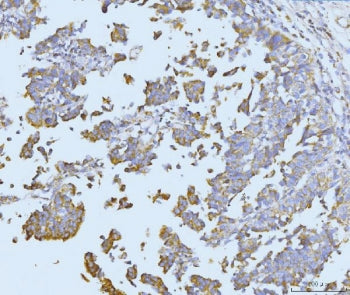IHC staining of FFPE human colonic adenocarcinoma tissue with ETFA antibody. HIER: boil tissue secti