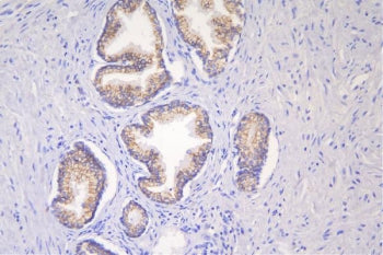 IHC staining of FFPE human prostate cancer with Desmoglein 2 antibody. HIER: boil tissue sections in