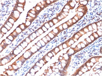IHC testing of FFPE human small intestine carcinoma with recombinant Villin antibody (clone rVIL1/13