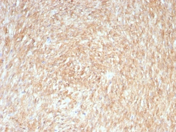 IHC testing of FFPE human gastrointestinal stromal tumor (GIST) with ANO1 antibody (clone rDG1/8750)