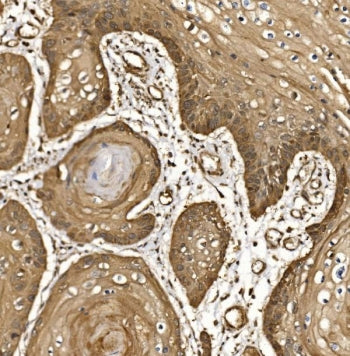 IHC staining of FFPE human esophageal squamous carcinoma tissue with Eukaryotic translation initiati
