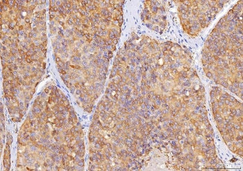 IHC staining of FFPE human liver cancer tissue with Sorbitol Dehydrogenase antibody. HIER: boil tiss
