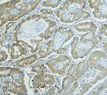 IHC staining of FFPE human rectal cancer with RPL13A antibody. HIER: boil tissue sections in pH6, 10