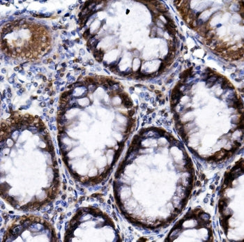 IHC staining of FFPE human rectal cancer with HIF1A antibody. HIER: boil tissue sections in pH8 EDTA