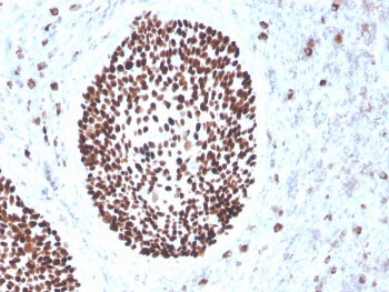 IHC staining of FFPE human cervix with recombinant SOX2 antibody (clone rSOX2/1791). HIER: boil tiss