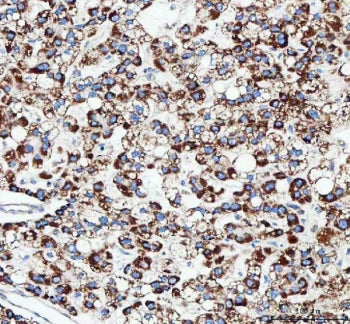 IHC staining of FFPE human liver cancer tissue with TFAM antibody. HIER: boil tissue sections in pH8