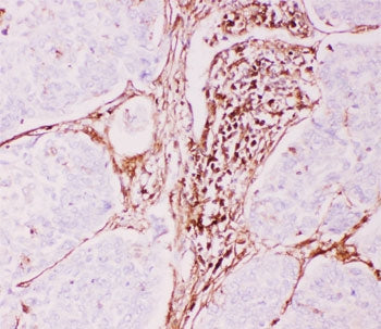 IHC-P: P Glycoprotein antibody testing of human lung cancer tissue