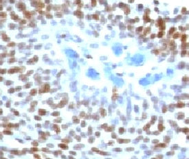IHC staining of FFPE human colon carcinoma with p53 antibody (clone CTA53-1). FFPE testing requires 