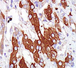IHC testing of FFPE human cancer tissue with SGK3 antibody. HIER: steam section in pH6 citrate buffe