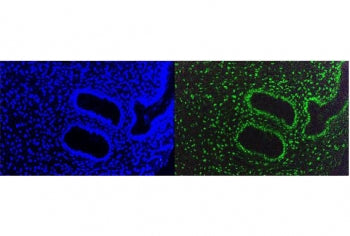 Immunofluorescent staining of FFPE human breast cancer cells with TRIM28 antibody (green) and DAPI n