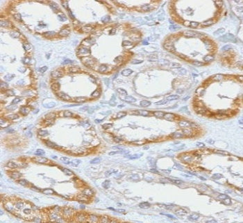 IHC testing of FFPE human renal cell carcinoma with CD61 antibody (clone PMGP3-1R). Required HIER: b