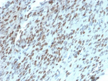 IHC testing of FFPE human GIST with TLE1 antibody (clone TLE1/2062). Required HIER: boil tissue sect