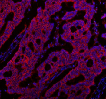 Immunofluorescent staining of FFPE human colon cancer tissue with NKCC1 antibody (red) and DAPI nucl