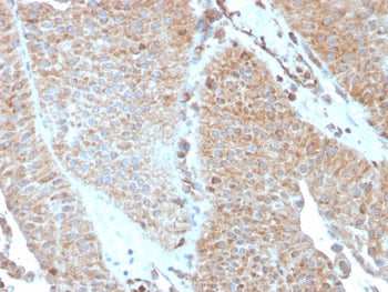 IHC testing of FFPE human urothelial carcinoma with SERBP1 antibody (clone SERBP1/3493). Required HI