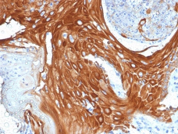 IHC testing of FFPE human basal cell carcinoma with Cytokeratin 6 antibody (clone KRT6A/2368). Requi
