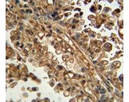 ABCG1 antibody immunohistochemistry analysis in formalin fixed and paraffin embedded human lung carc