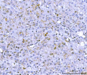 IHC staining of FFPE human liver cancer tissue with PCSK9 antibody. HIER: boil tissue sections in pH