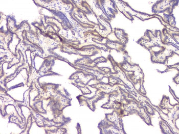 IHC staining of FFPE human thyroid cancer with BMP15 antibody at 1ug/ml. HIER: boil tissue sections 
