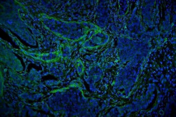 Immunofluorescent staining of FFPE human breast cancer tissue with Vinculin antibody (green) and DAP