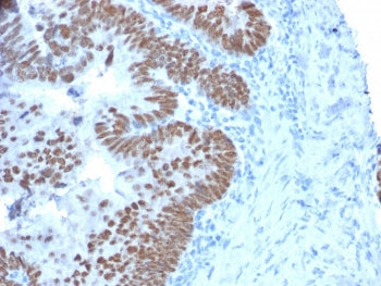 IHC testing of FFPE human colon carcinoma with CDX2 antibody (clone CDX2/2214). HIER: boil tissue se
