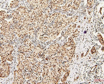 IHC staining of FFPE human breast cancer with DDX5 antibody. HIER: boil tissue sections in pH6, 10mM