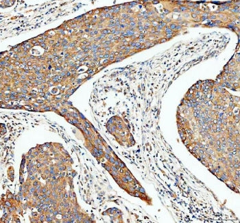 IHC staining of FFPE human esophageal cancer tissue with Transferrin antibody. HIER: boil tissue sec