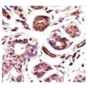 IHC testing of FFPE human breast cancer tissue with Ubiquitin-protein ligase E3A antibody. HIER: ste