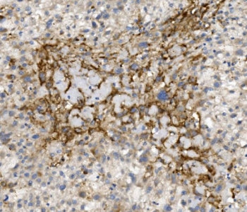 IHC staining of FFPE human liver cancer with CCR2 antibody. HIER: boil tissue sections in pH8 EDTA f
