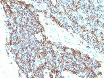 IHC: Formalin-fixed, paraffin-embedded human Ewing's sarcoma stained with CD99 antibody (clones 12E7