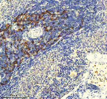 Immunohistochemical staining of GLIPR2 using anti-GLIPR2 antibody. GLIPR2 was detected in a paraffin