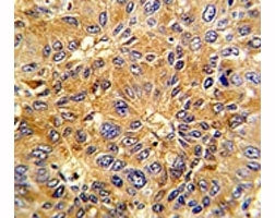 IHC analysis of FFPE human hepatocarcinoma with Cyclin A2 antibody