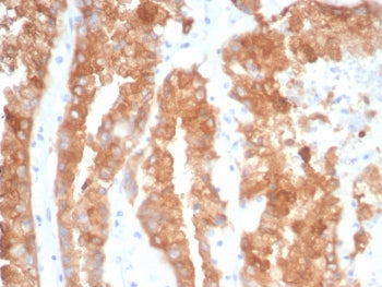 IHC staining of FFPE human prostate cancer tissue with Crystallin Alpha B antibody (clone CRYAB/4663