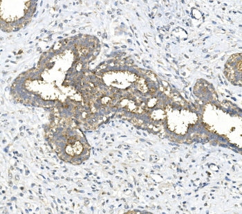 IHC staining of FFPE human breast cancer with Galactosidase alpha antibody. HIER: boil tissue sectio