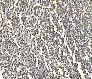 IHC staining of FFPE human pancreatic cancer with ATG9A antibody. HIER: boil tissue sections in pH8 