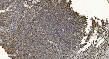 IHC staining of FFPE human lymph node metastasis in gastric cancer with hnRNP H3 antibody. HIER: boi