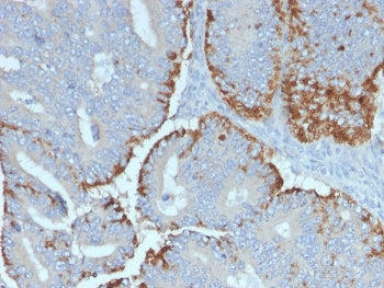 IHC staining of FFPE human colon carcinoma with ATG5 antibody. HIER: boil tissue sections in pH 9 10