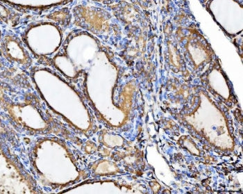 IHC staining of FFPE human thyroid cancer tissue with CHM antibody. HIER: boil tissue sections in pH