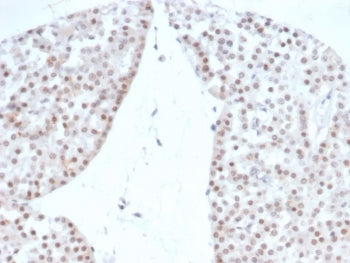 IHC staining of FFPE human renal oncocytoma with recombinant Steroidogenic Factor 1 antibody (clone 