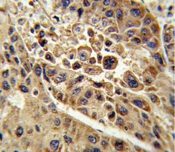 IHC testing of FFPE human hepatocellular carcinoma tissue with KMO antibody. HIER: steam section in 