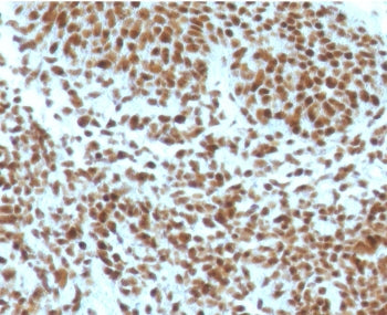 IHC staining of FFPE human basal cell carcinoma with NPM antibody (clone NLPP1-1). HIER: boil tissue