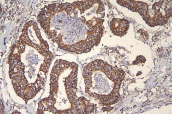 IHC staining of FFPE human rectal cancer with mtTFA antibody. HIER: boil tissue sections in pH6, 10m