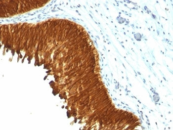 IHC: Formalin-fixed, paraffin-embedded human bladder carcinoma stained with Multi Cytokeratin antibo