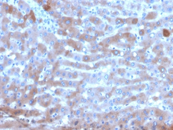 IHC staining of FFPE human hepatocellular carcinoma tissue with Transferrin antibody (clone TF/4795)