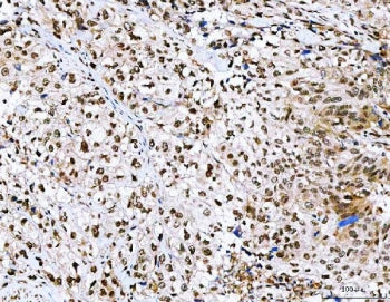 IHC staining of FFPE human urothelial carcinoma tissue with NVL antibody. HIER: boil tissue sections